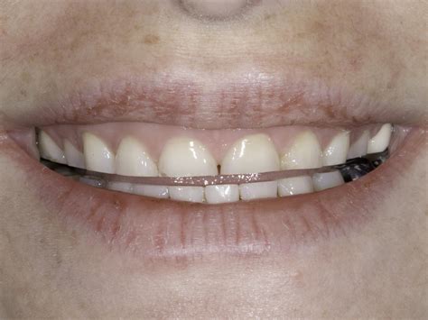 Causes of Bruxism | Tooth Grinding | Facts and Theories