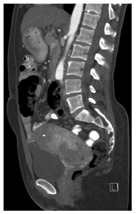 Desmoplastic Small Round Cell Tumor of the Uterus: A Report of ...