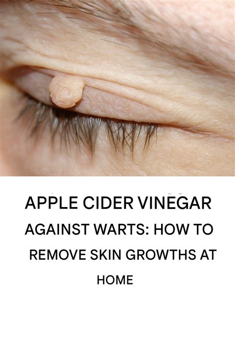Apple cider vinegar against warts: how to remove skin growths at home ...