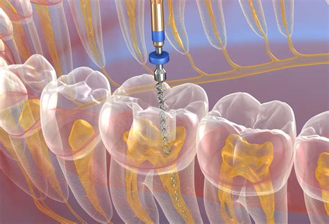 What Is A Endodontist