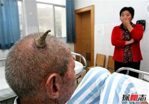百岁老人头上长“犄角”之谜，预示癌症病变(皮肤肿瘤)_探秘志