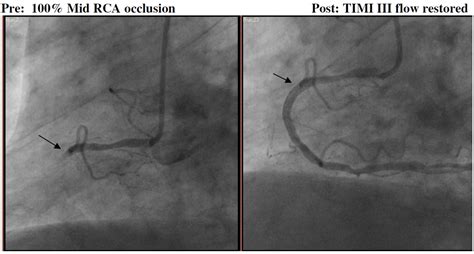 Image result for STEMI Cath Lab