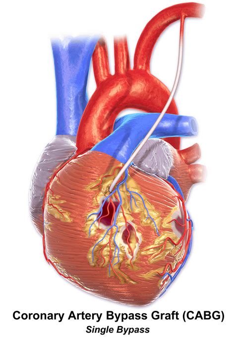 Coronary Artery Bypass Grafting (CABG) - almostadoctor