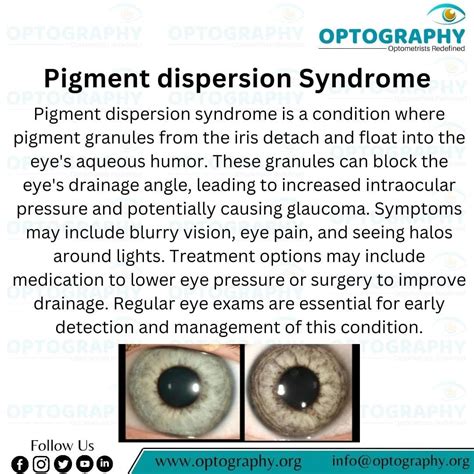 OPTOGRAPHY on LinkedIn: #pigmentdispersionsyndrome #eyehealth #glaucoma ...