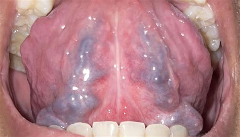 Enlarged Veins Under Tongue: Causes & Tips