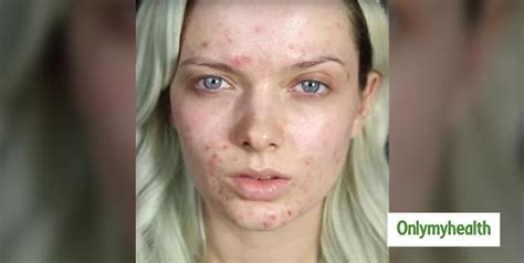 Does Vitamin B12 Deficiency Cause Skin Rash Problems? | OnlyMyHealth