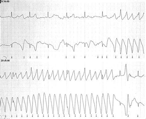 Electrocardiographic artefact mimicking arrhythmic change on the ECG ...