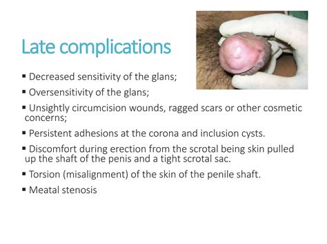 Basic technique of circumcision by regi septian | PPSX