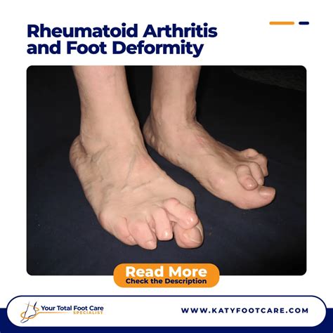 Rheumatoid Arthritis Feet Early Signs