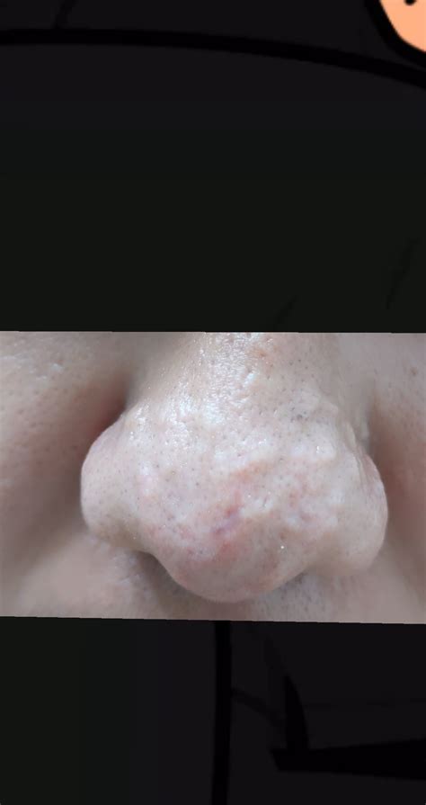 Acne Scars Bumps On Nose at Amelia Rodrigues blog