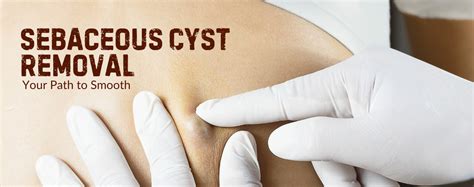 Image result for Sebaceous Cyst Removal Procedure