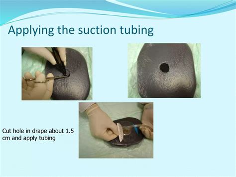 VACUUM ASSISTED WOUND THERAPY | PPTX