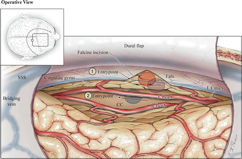 Image result for Graffted Contralateral