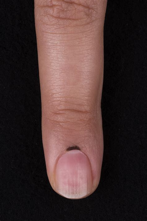 Melanoma of the proximal nail fold mimicking Hutchinson sign - JAAD ...