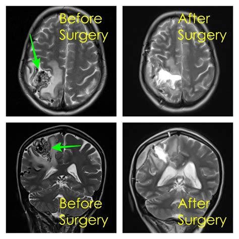 Arteriovenous Brain Malformation Surgery Johannesburg