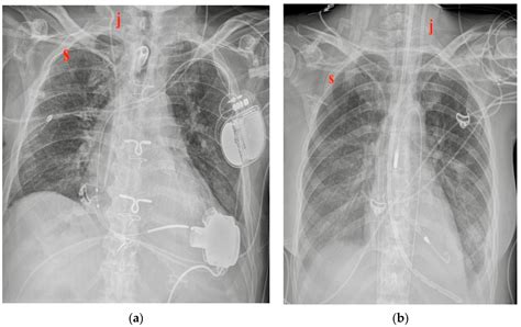 Chest X-ray Interpretation: Detecting Devices and Device-Related Complications