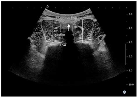 Lumbar Multifidus Muscle Morphology Changes in Patient with Different ...