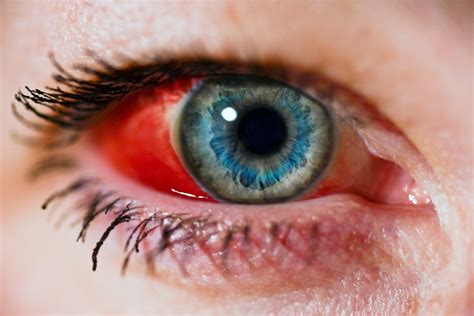 Blood Vessels In Eye