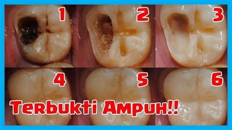 cara mengatasi gigi sakit saat bersentuhan dengan gigi lain