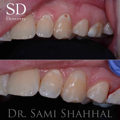 Front Tooth Cavity At Gum Line