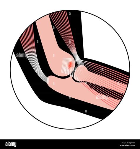 Illustration of tennis elbow, or lateral epicondylitis Stock Photo - Alamy