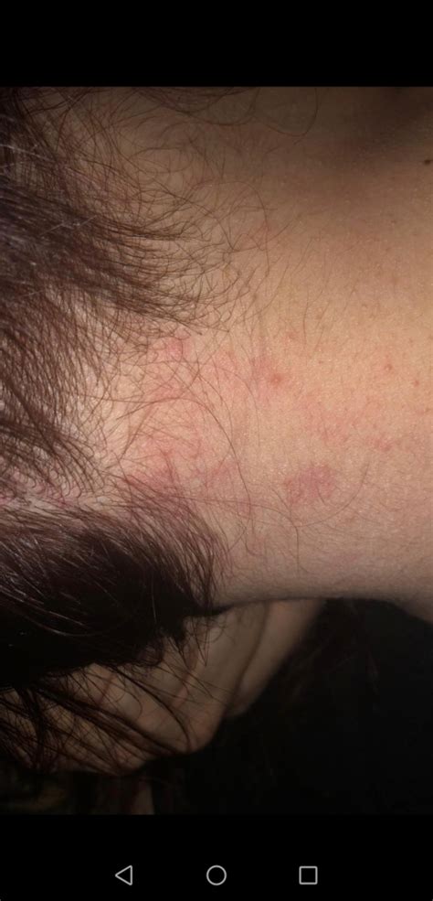 Shingles on scalp or not? | Shingles | Forums | Patient