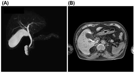 Acute Calculous Cholecystitis Caused by Streptococcus gallolyticus ...