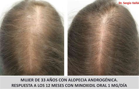 Alopecia En Mujeres