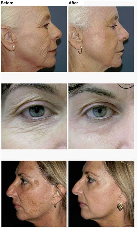 Fractional Laser