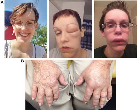 Oral dose of Sebetralstat improves symptoms in acute hereditary ...