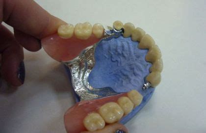 ᐉ Bugel prosthesis with fixation on lock fasteners in Dentistry «Denta.UA»