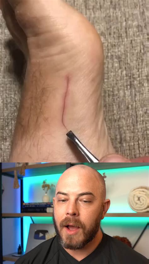 Image result for Hair Splinter Infection