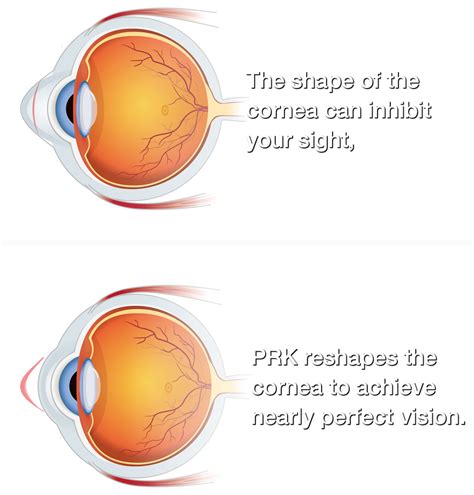 Eye Makeup After Prk Surgery at Victoria Otero blog