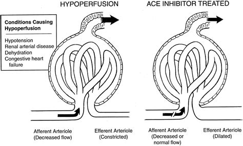 Acute Renal Failure with ACE Inhibitors - MEDizzy
