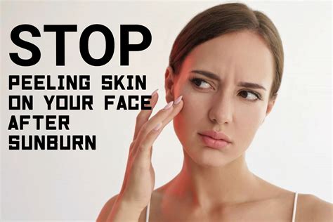 Stop Face Peeling From Sunburn at David Laramie blog