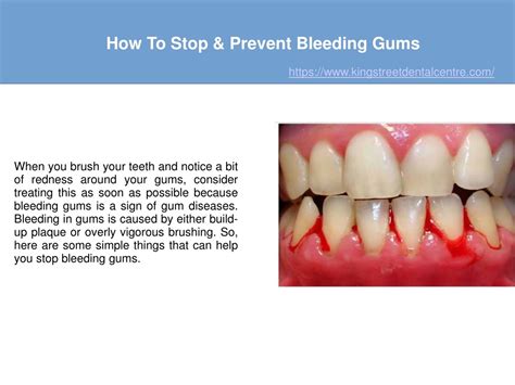 PPT - How To Stop & Prevent Bleeding Gums PowerPoint Presentation, free download - ID:8483819