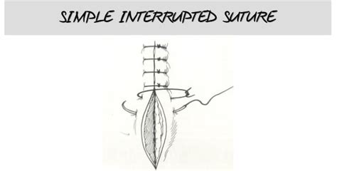 Basic Interrupted Suture 的图像结果