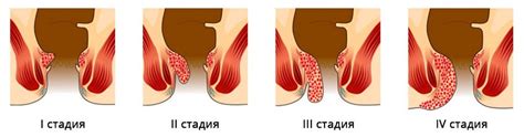 Геморрой