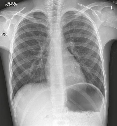 Pigg-o-Stat: What To Know About Baby Xrays BabyCenter