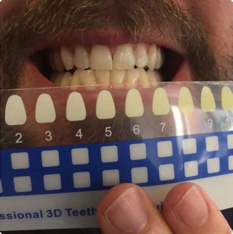 Top 6 Foods & Drinks That Cause Teeth Staining, and How to Prevent It ...