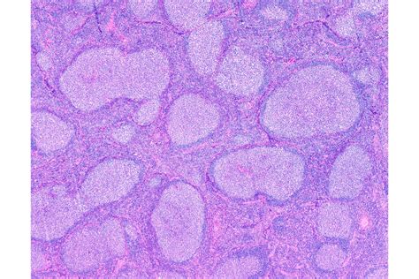 ASH 2022: Trials Show Promising Results in Follicular Lymphoma - Cancer Therapy Advisor