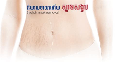 Stretch mark removal | Royal Phnom Penh Hospital