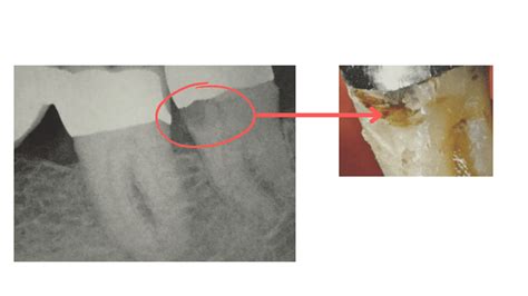 My Teeth are Decaying at the Gum Line: What You Need to Know