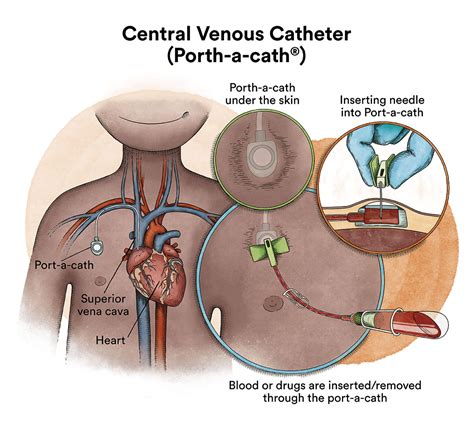 Acute myeloid leukaemia - Josep Carreras Foundation
