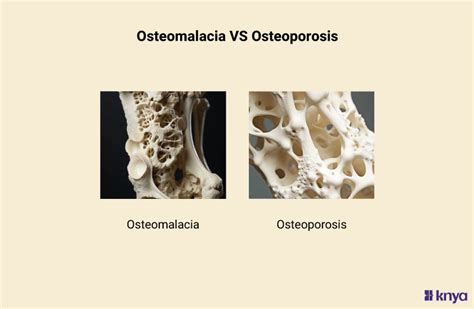 Osteomalacia vs Osteoporosis | Know the differences & Similarities – Knya