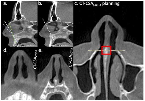 Comparison of Cottle-Area-2 and Cottle-Area-3 in Computed Tomography ...