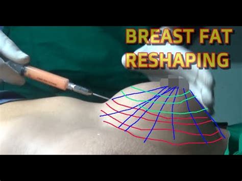 Kuvatulokset haulle breast reconstruction with fat transfer