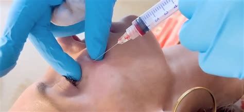 PRF Protocol 的图像结果