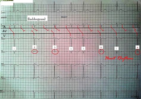 Ecg Criteria For Complete Heart Block at Ken Escobar blog