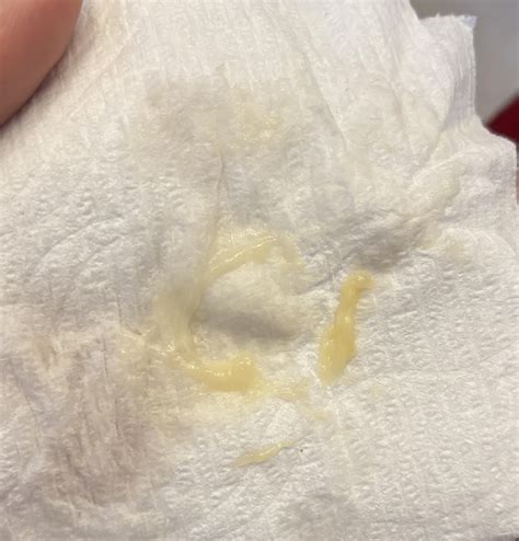 Yellow Discharge for seemingly no reason : r/obgyn
